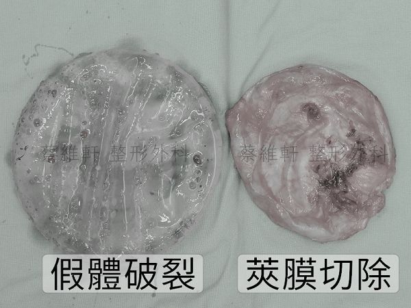 假體破裂導致攣縮，做莢膜全切除手術。高雄蔡維軒醫師