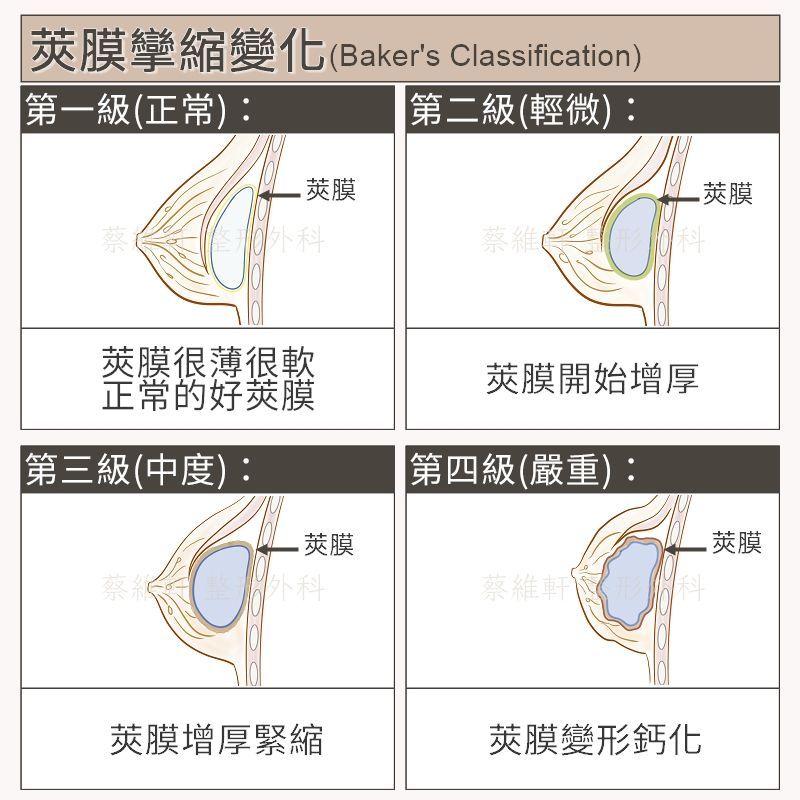 高雄隆乳推薦-蔡維軒醫師-莢膜攣縮貝克分級表 