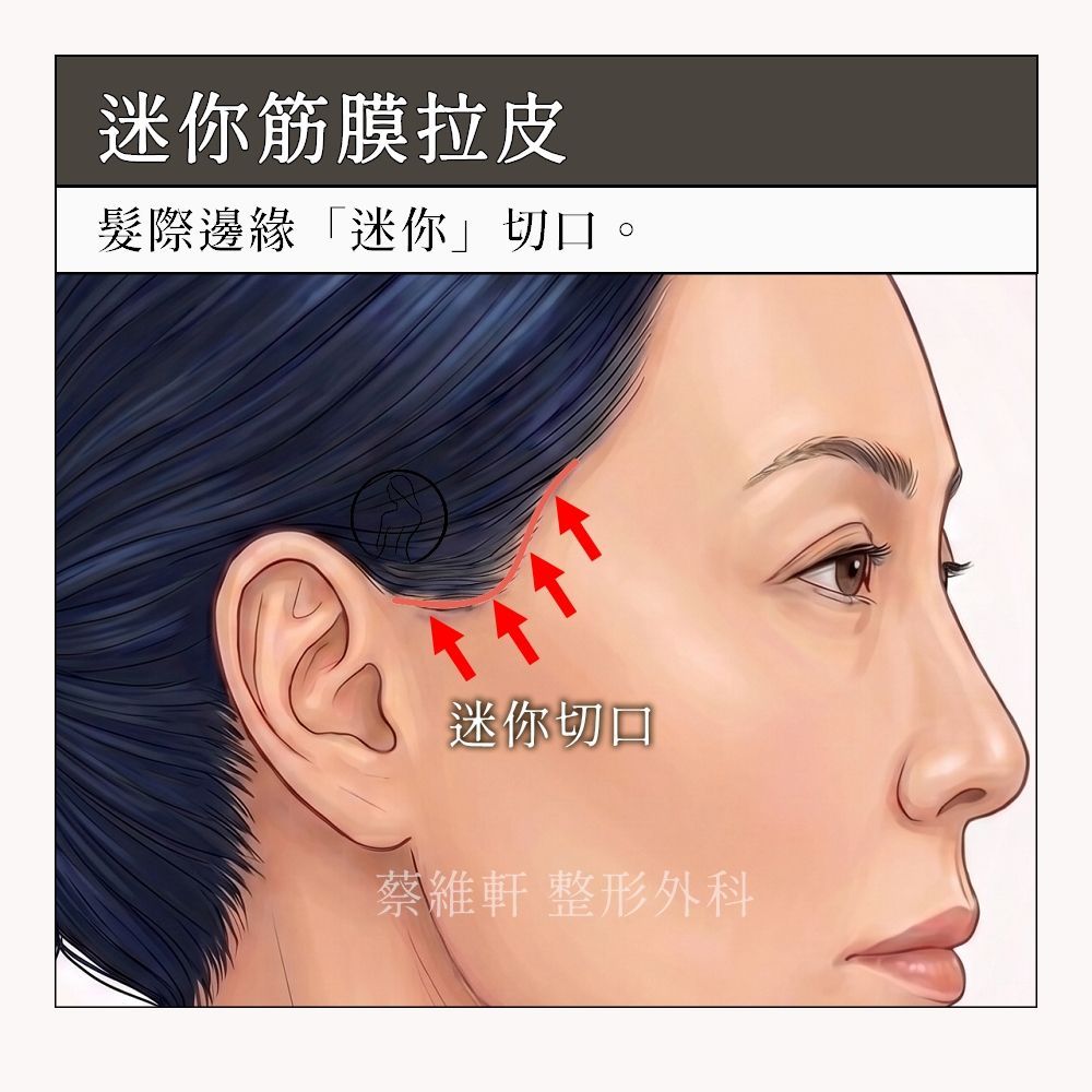 迷你筋膜拉皮,髮際到耳前的迷你切口,約5公分左右。