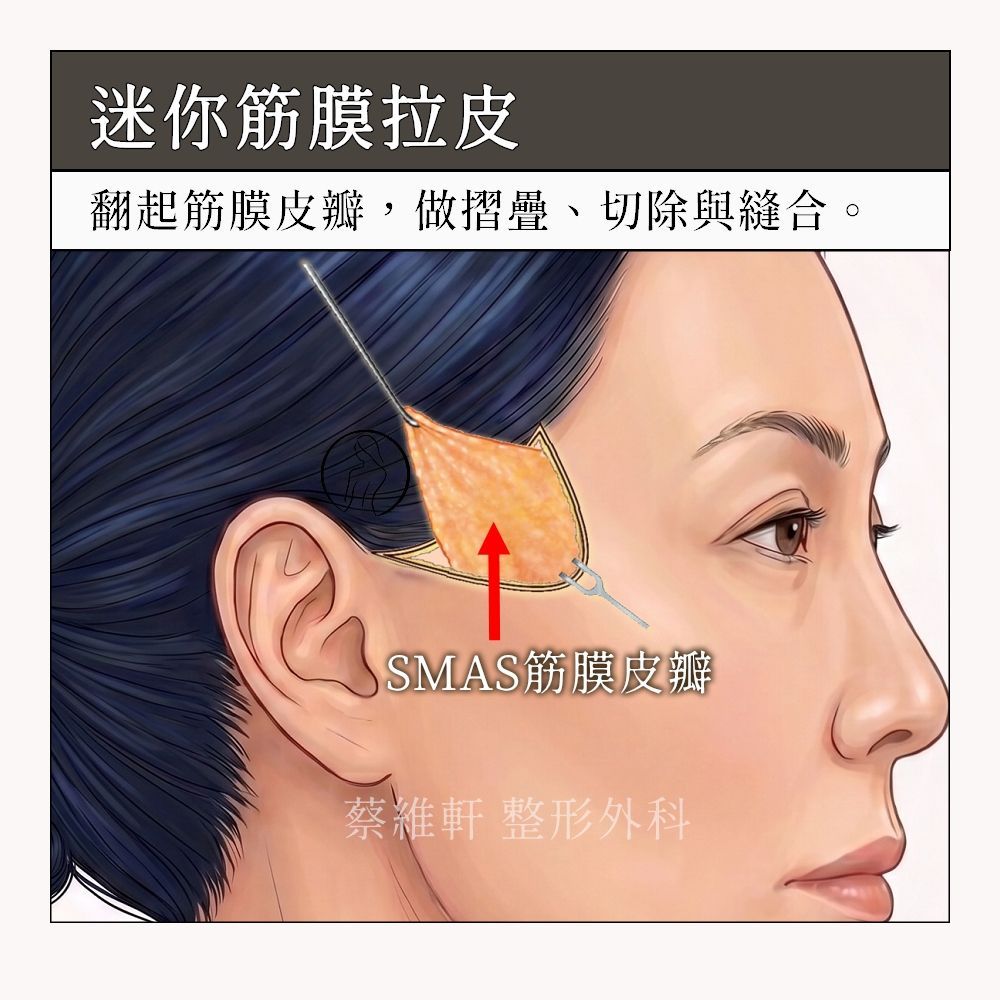 迷你筋膜拉皮,翻起SMAS筋膜皮瓣,做拉提、折疊、縫合和切除,達到有效且持久的拉提效果。