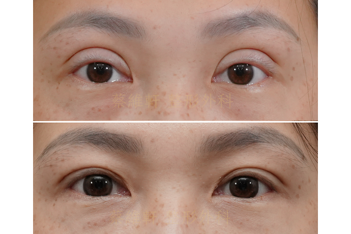 雙眼皮重修手術，降窄原本過寬、肉條感重的雙眼皮
