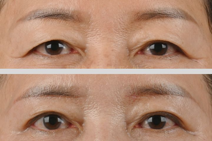 眉下切+三爪釘眉毛固定術