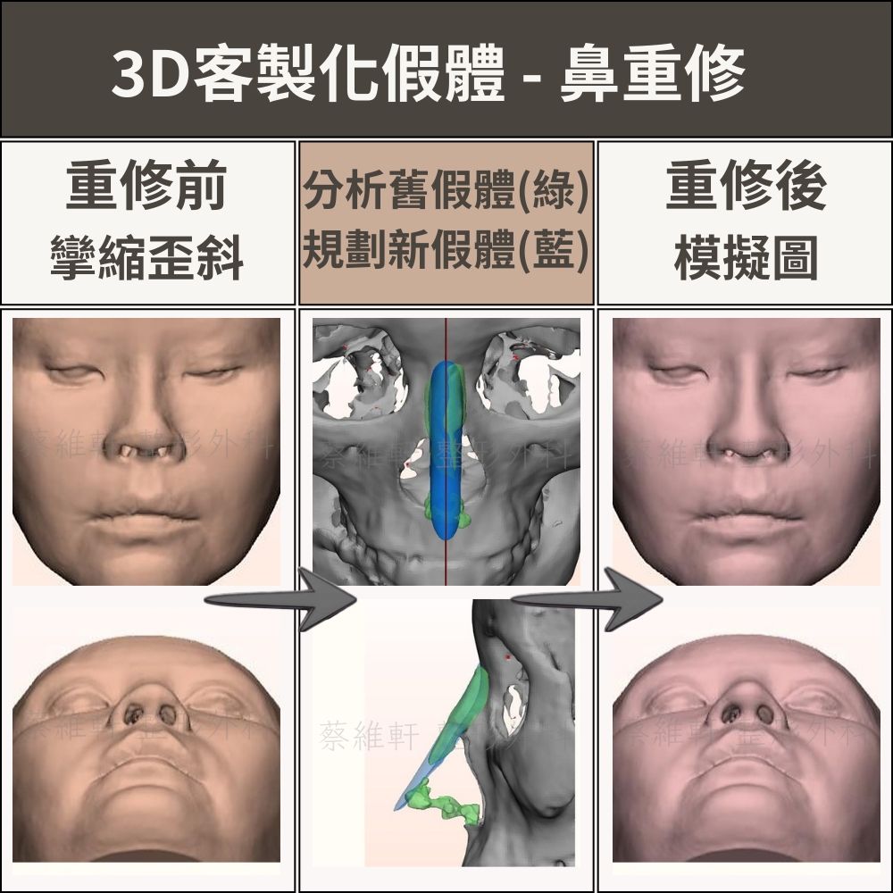 Bistool Softxil -二代矽膠 雙重硬度 軟矽膠與硬矽膠 Bistool Softxil -二代矽膠 雙重硬度 軟矽膠與硬矽膠