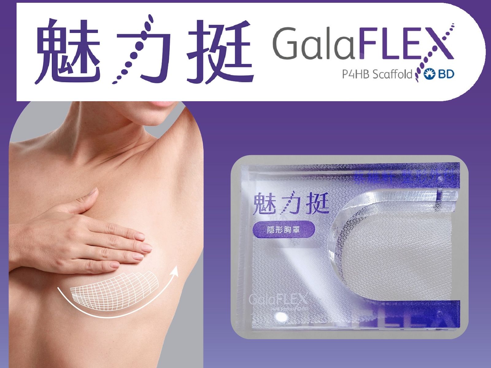 圖中描繪了一名女性的軀幹，其中一側乳房增大，粉紅色箭頭指示可能的隆乳手術部位。