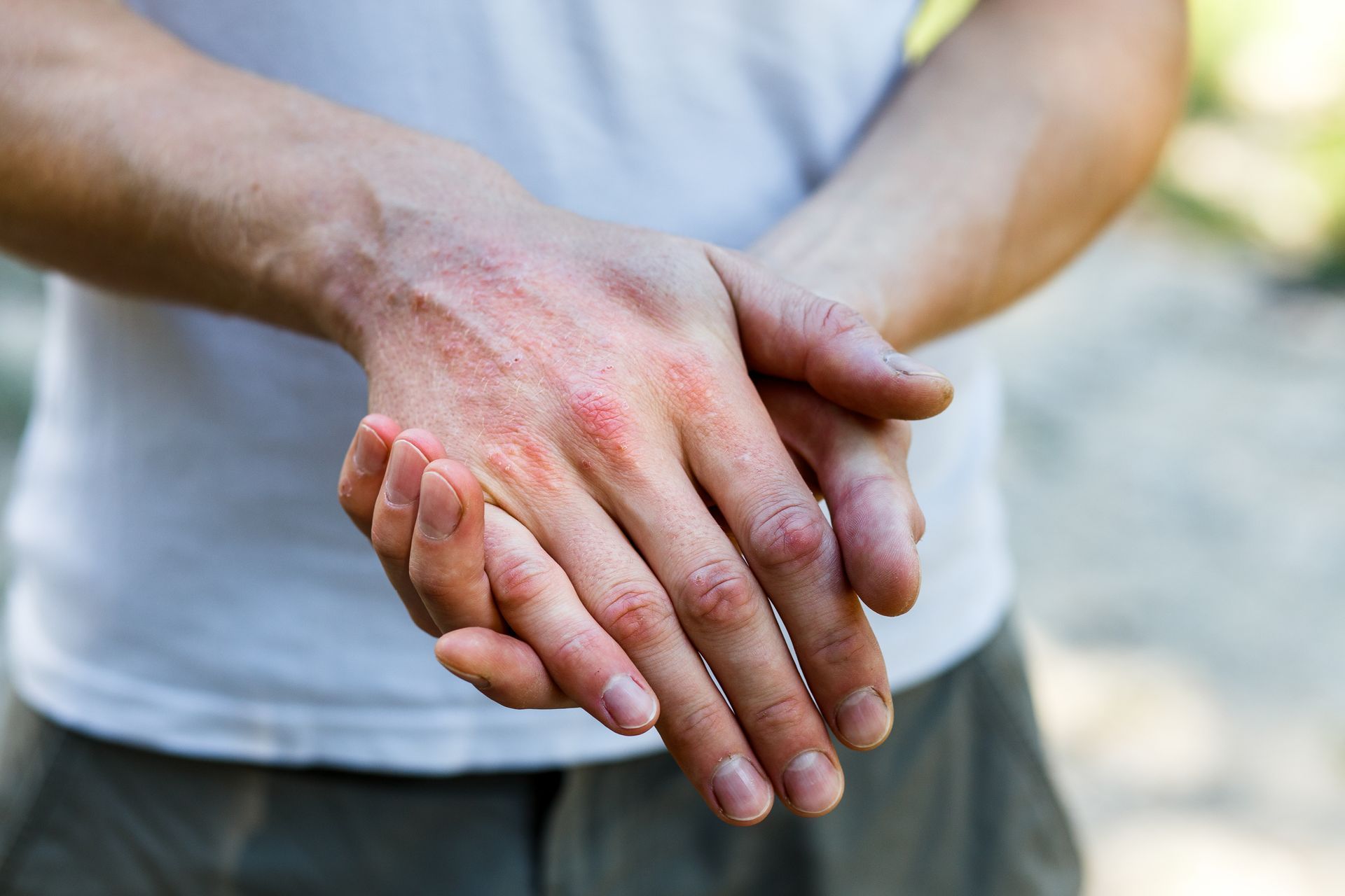 Person scratching red irritated hands showing dermatitis symptoms and skin inflammation close-up.