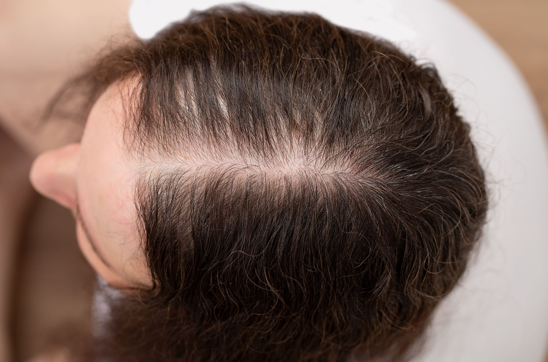 A woman with hair loss on the top of her head.
