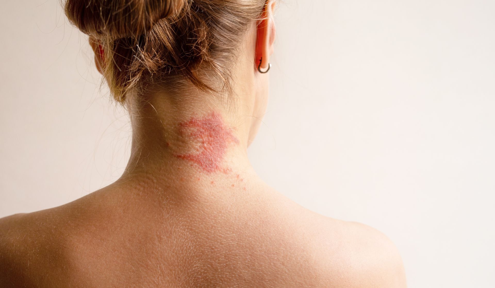 Manifestation of atopic dermatitis as a red itchy spot on a woman’s neck.