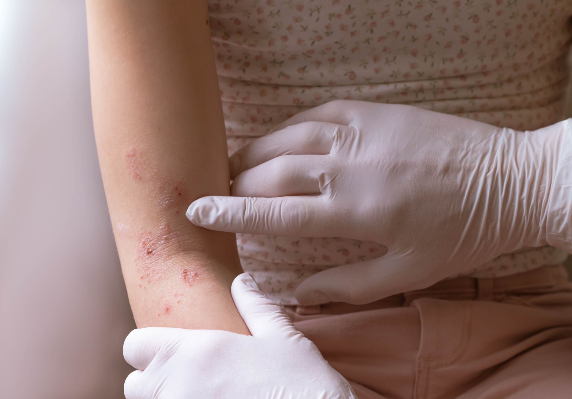A Patient With Eczema - New Bern, NC - ECDSS
