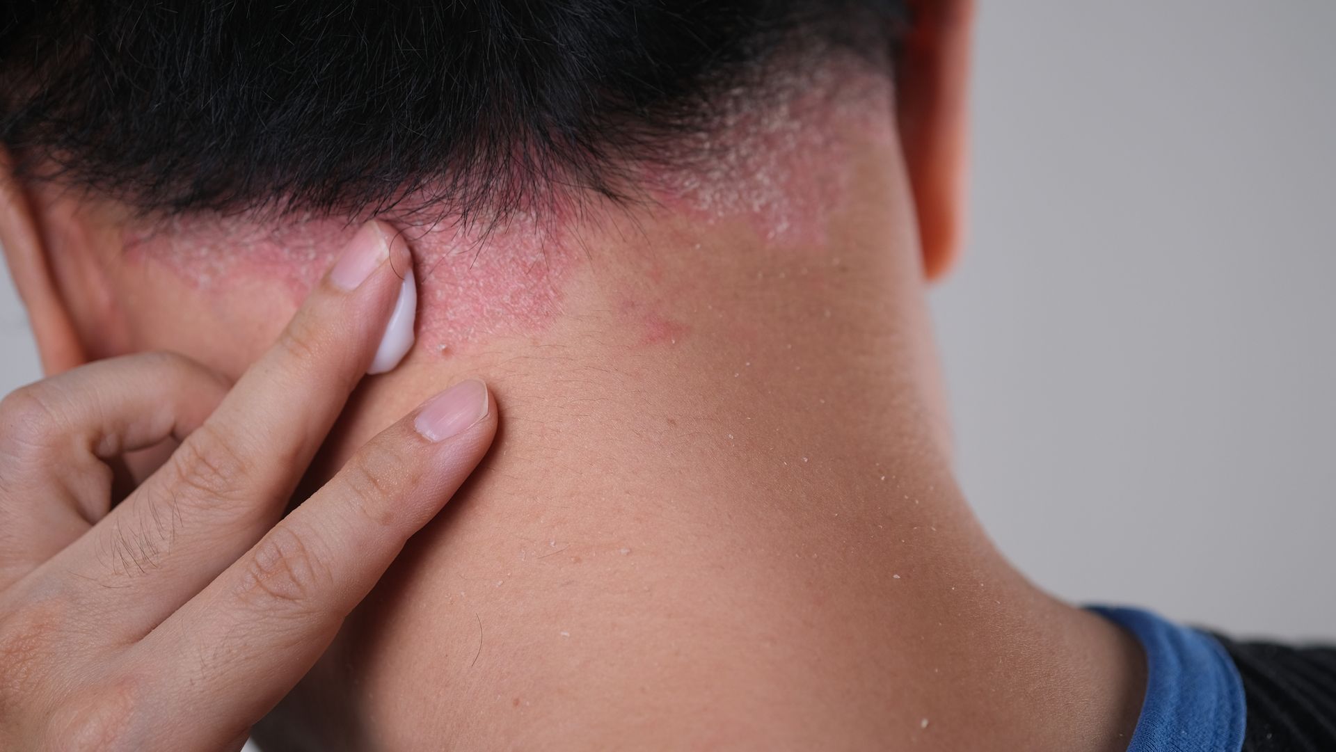 Applying Ointment To Psoriasis - New Bern, NC - ECDSS