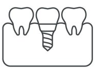 Un dessin au trait d'un implant dentaire entre deux dents.