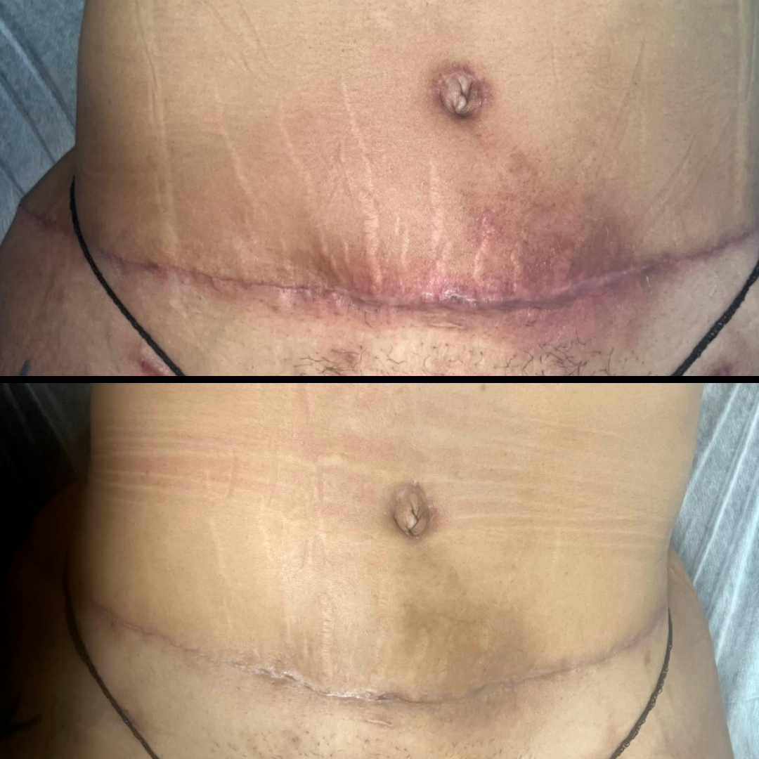 Two pictures of a woman 's stomach before and after surgery.