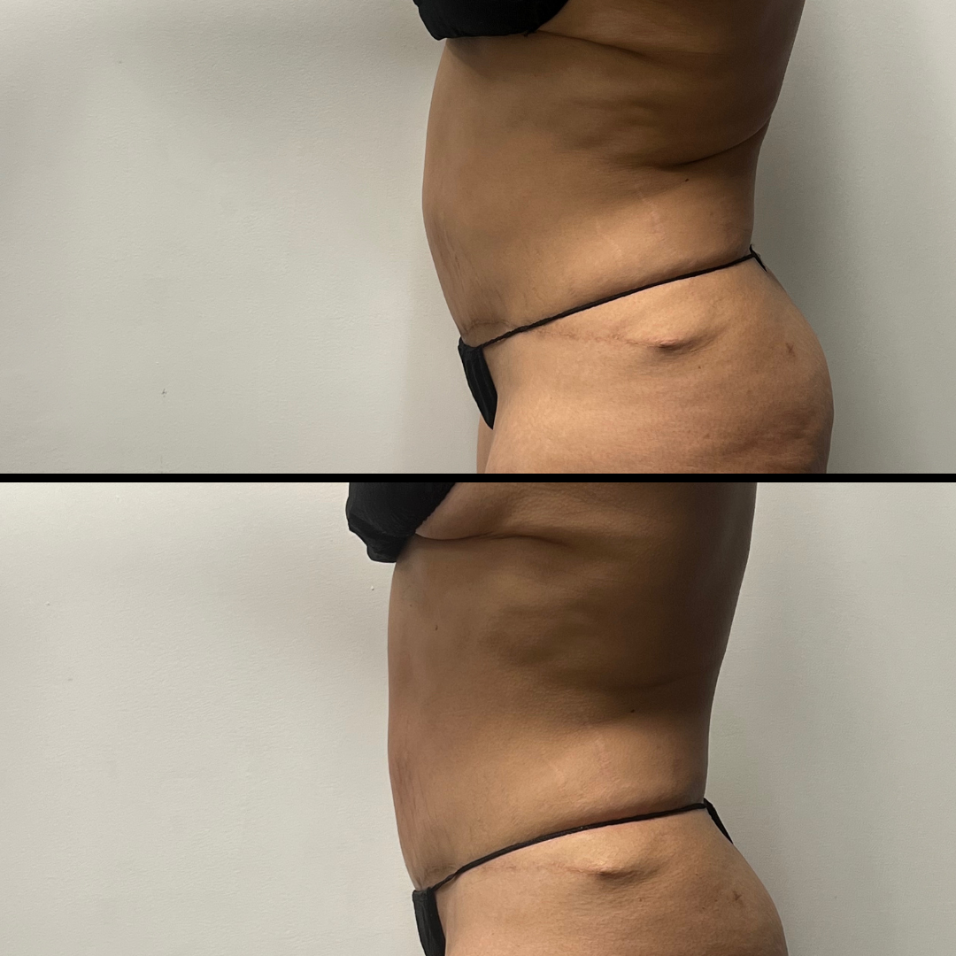 A before and after picture of a woman 's stomach