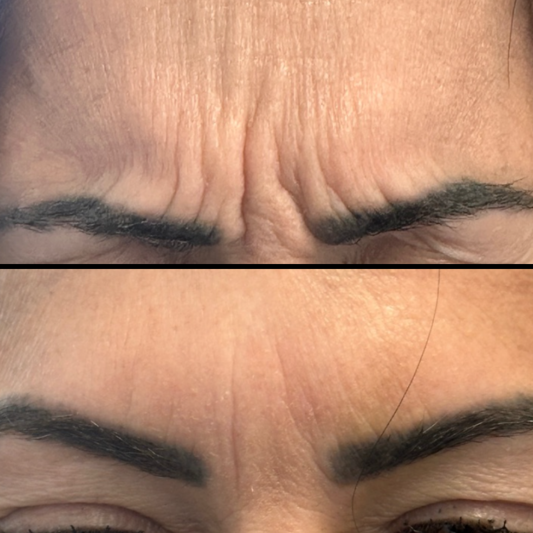 A before and after picture of a woman 's forehead with wrinkles and eyebrows.