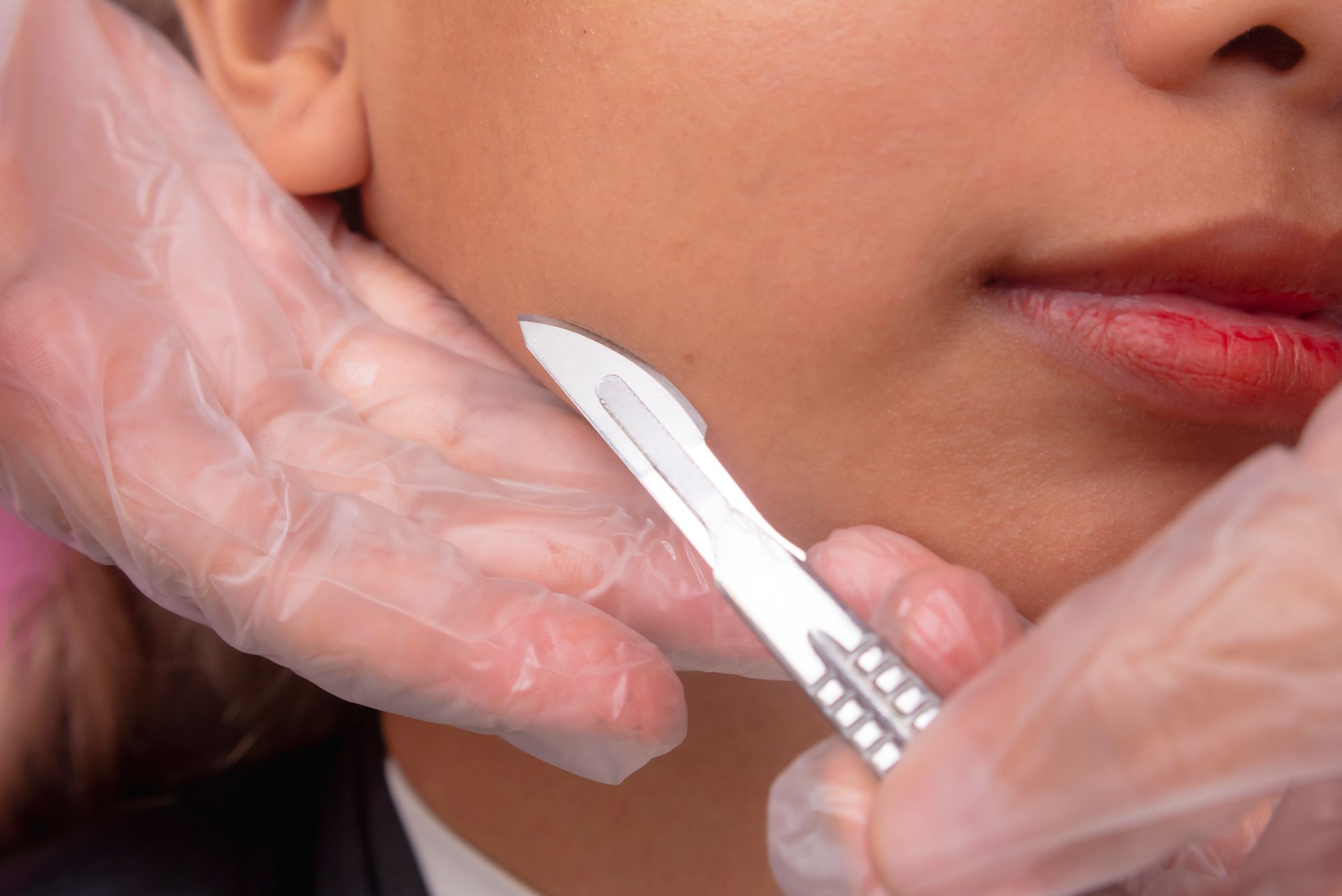 A woman is receiving a dermaplane treatment on her cheek with a scalpel