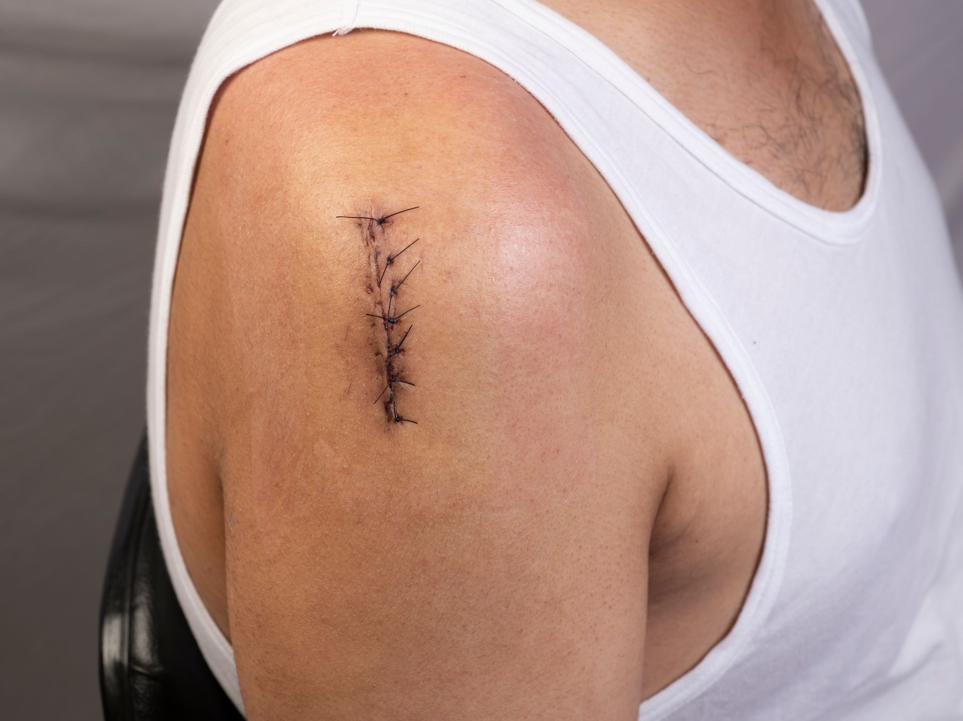 A man in a white tank top has a stitch on his shoulder.
