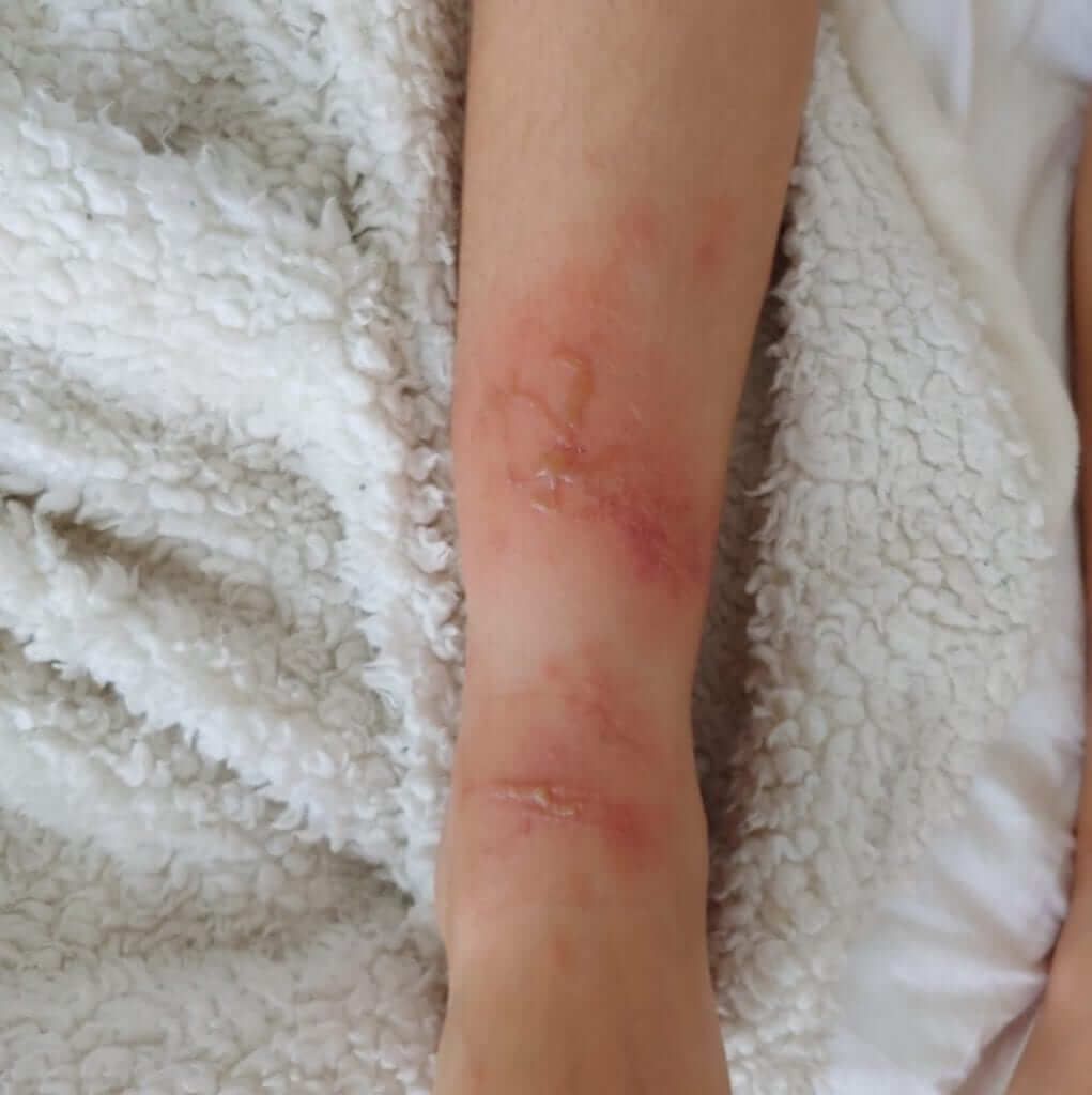 What a sting may look like on a victim