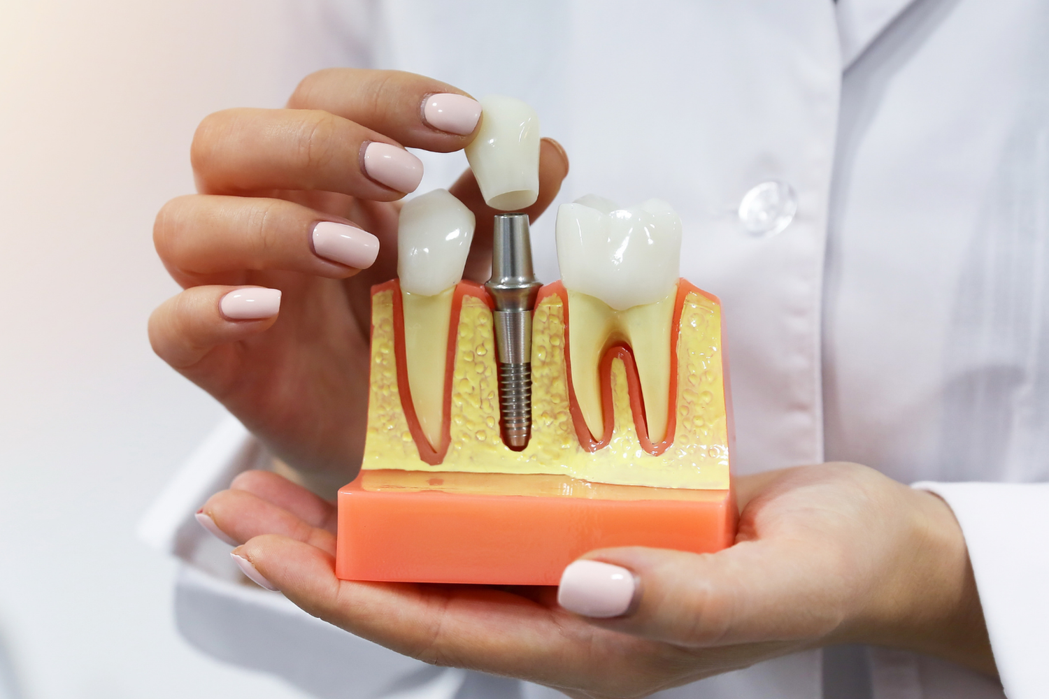 A professional holding a dental model demonstrating how a crown fits onto a metal implant post between two teeth.