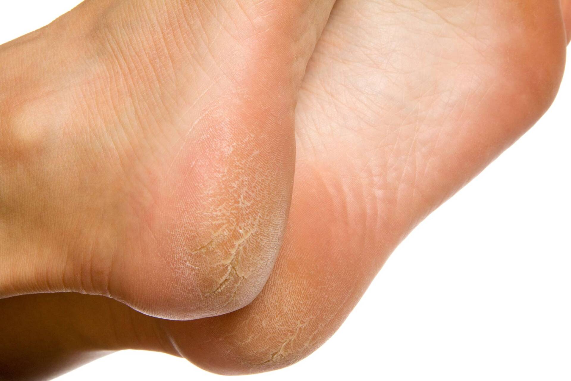 Cracked Heels | Norwest, NSW | Amy McElveney Podiatry