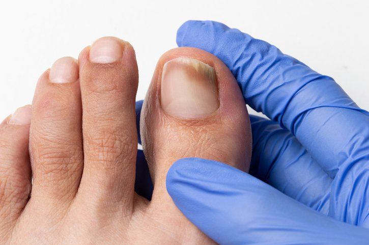 Fungal Nails | Norwest, NSW | Amy McElveney Podiatry