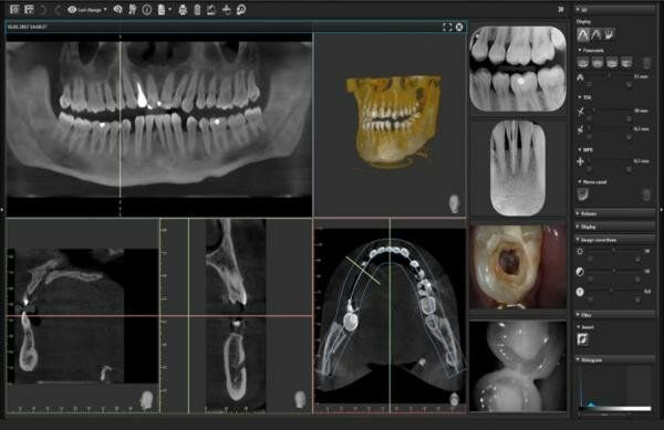 Visualização do software de raio-X odontológico. Múltiplas vistas mostram os dentes em tons de cinza e em 3D. Uma mira destaca um dente específico.