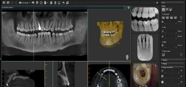Interface de software de raio-X odontológico exibindo imagens escaneadas dos dentes de um paciente.