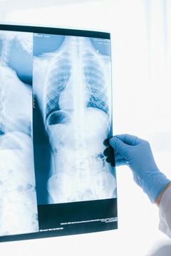 A doctor is holding an x-ray of a person 's chest.