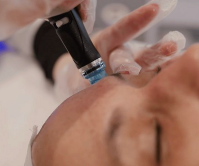 A woman is getting a facial treatment with a pen on her face.