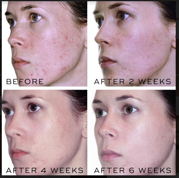 before after peeling acne