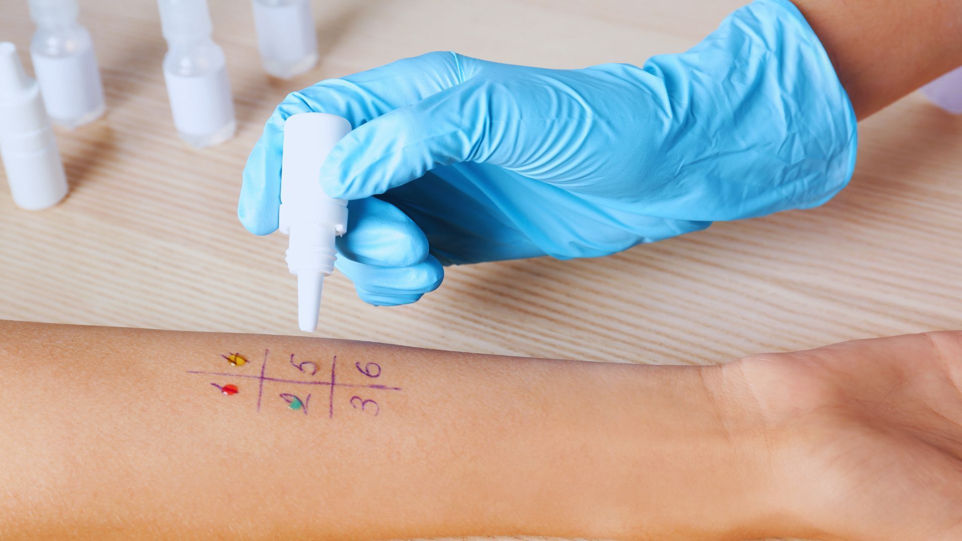 Una persona sta facendo un test allergologico sul braccio.
