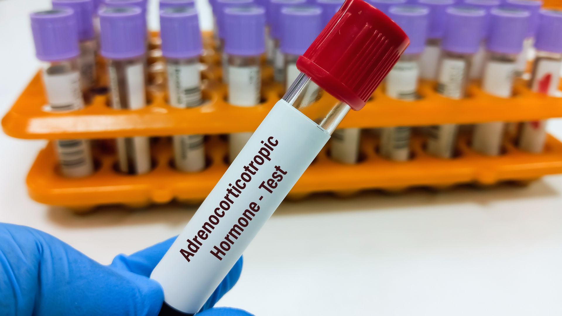 Una persona tiene in mano una provetta che dice test dell'ormone adrenocorticotropo