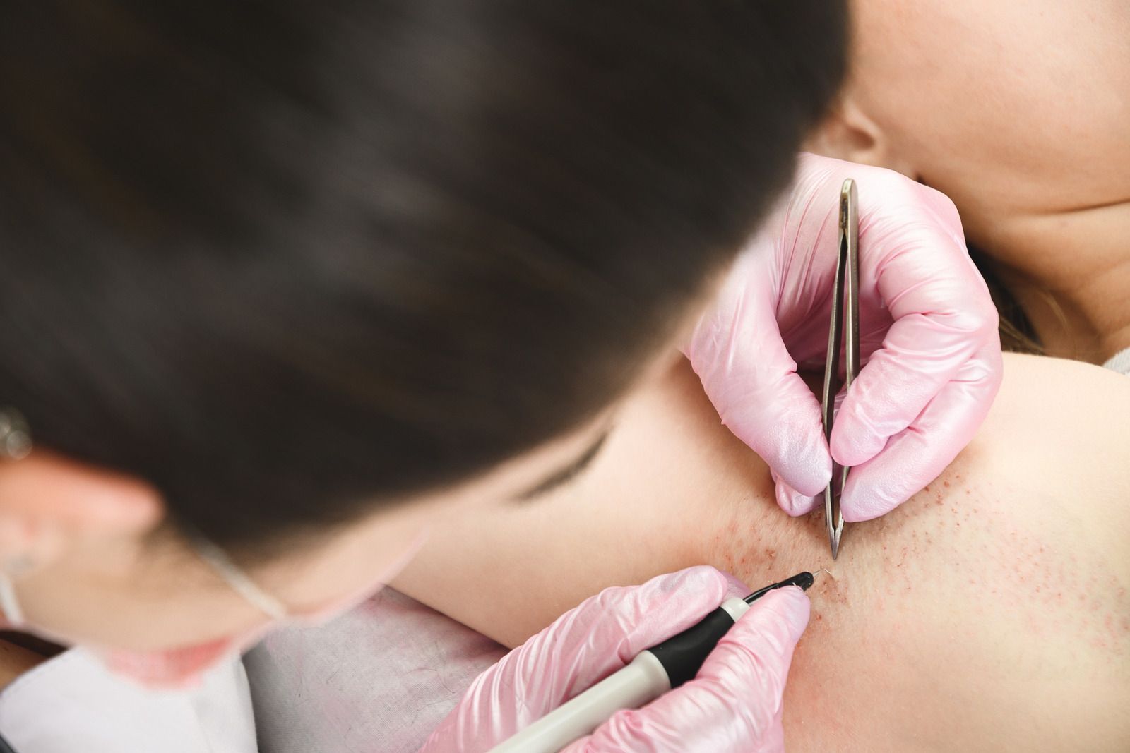 Gloved hands using tweezers and a tool to remove a small splinter from skin