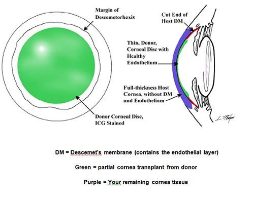 Corneal Transplant Support Group - Understanding the EYE CHART 20/20 or  6/6? Eye charts of different variations have become a standard in vision  screenings and eye exams. One of the most familiar