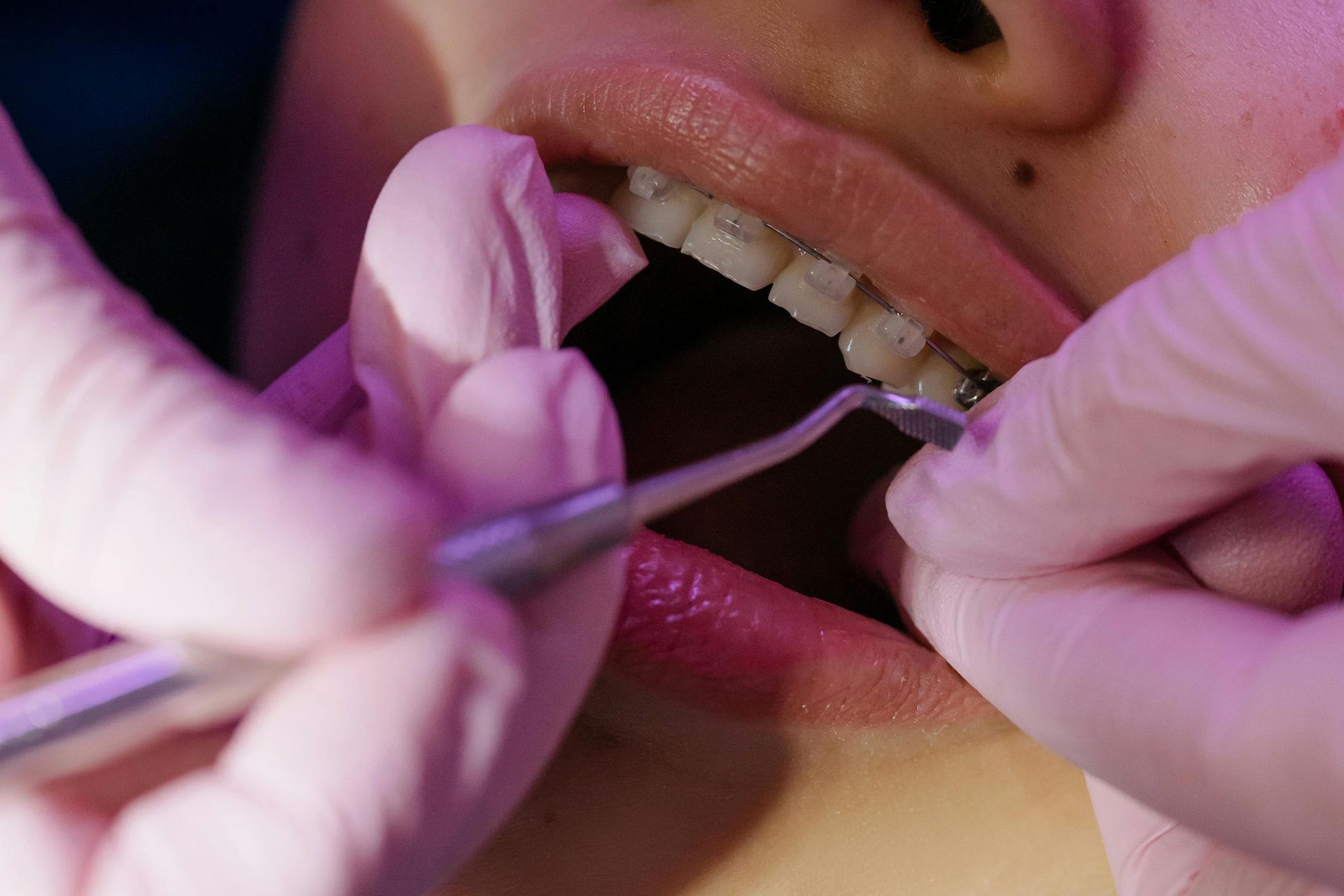 Dentist's hands with gloves using a dental tool on teeth with braces.