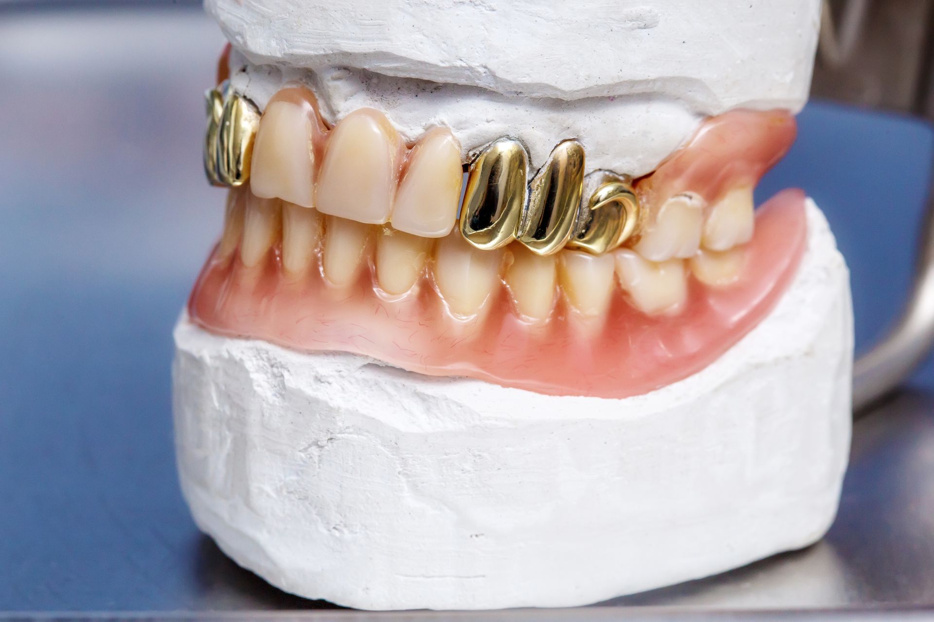 False teeth mold with gold caps and pink gums, set in white dental plaster.