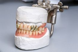 Dental mold with dentures, some teeth with gold caps, held in a metal device.