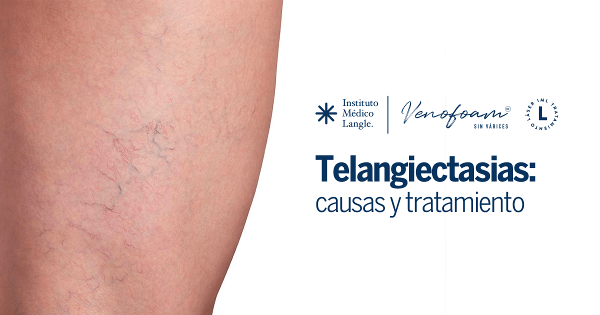 Telangiectasia en la Cara: Síntomas y Soluciones