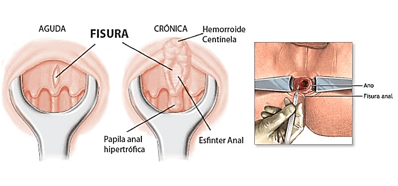 Diferencias entre una fisura anal y una hemorroide