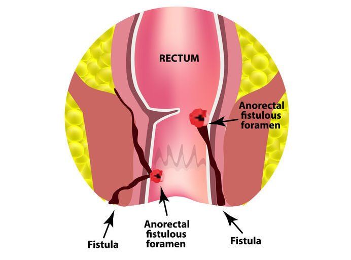 Tratamiento Para Fisura Anal