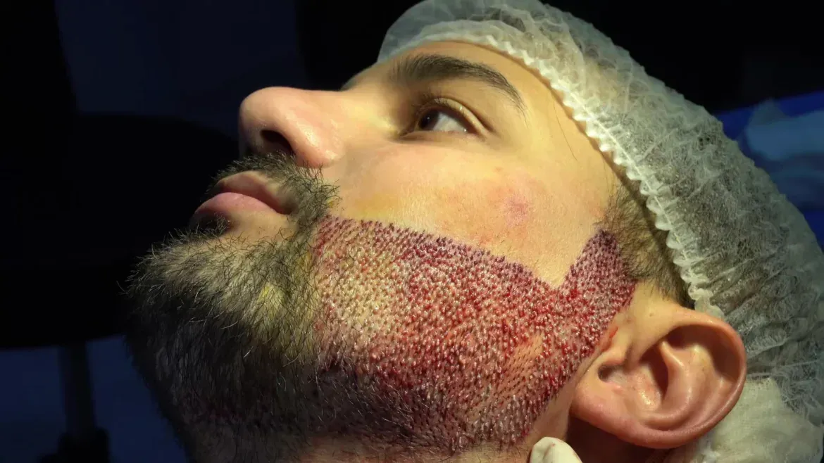 Man's face with a beard undergoing a hair transplant. Reddish dots mark implanted areas. He wears a surgical cap.