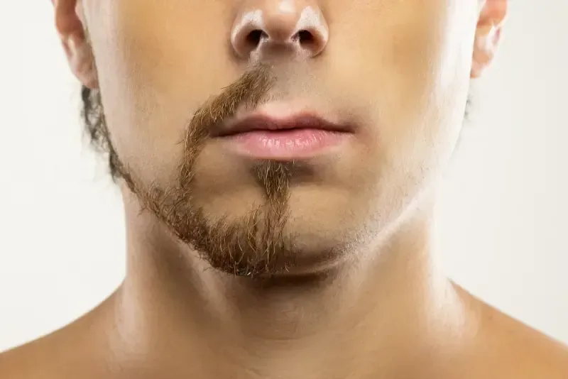 Close-up of a man's face with a beard on one side and shaved on the other.