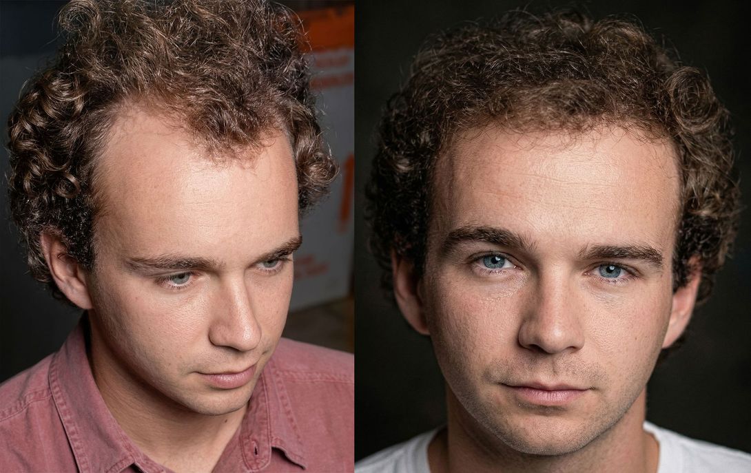 A side-by-side comparison of a person with a shaved head and the same person with a full head of hair.
