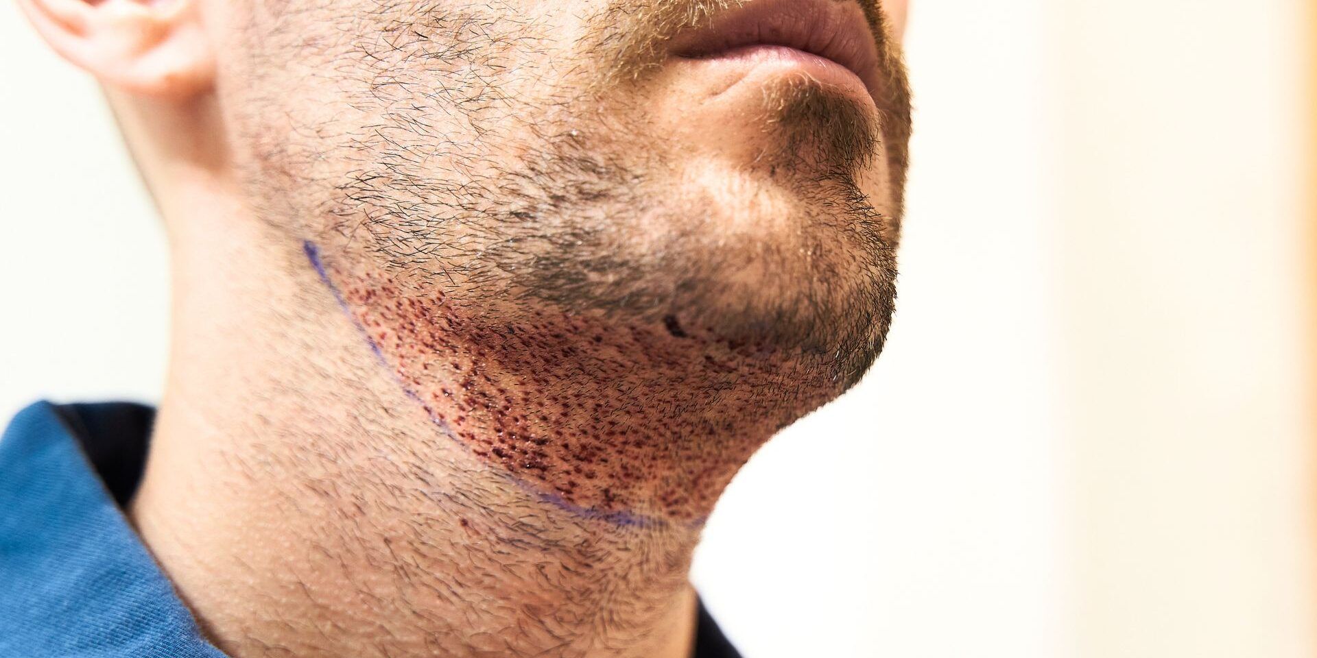 Close-up of a man's face and neck, showing stubble with red skin and blue markings, likely after a procedure.