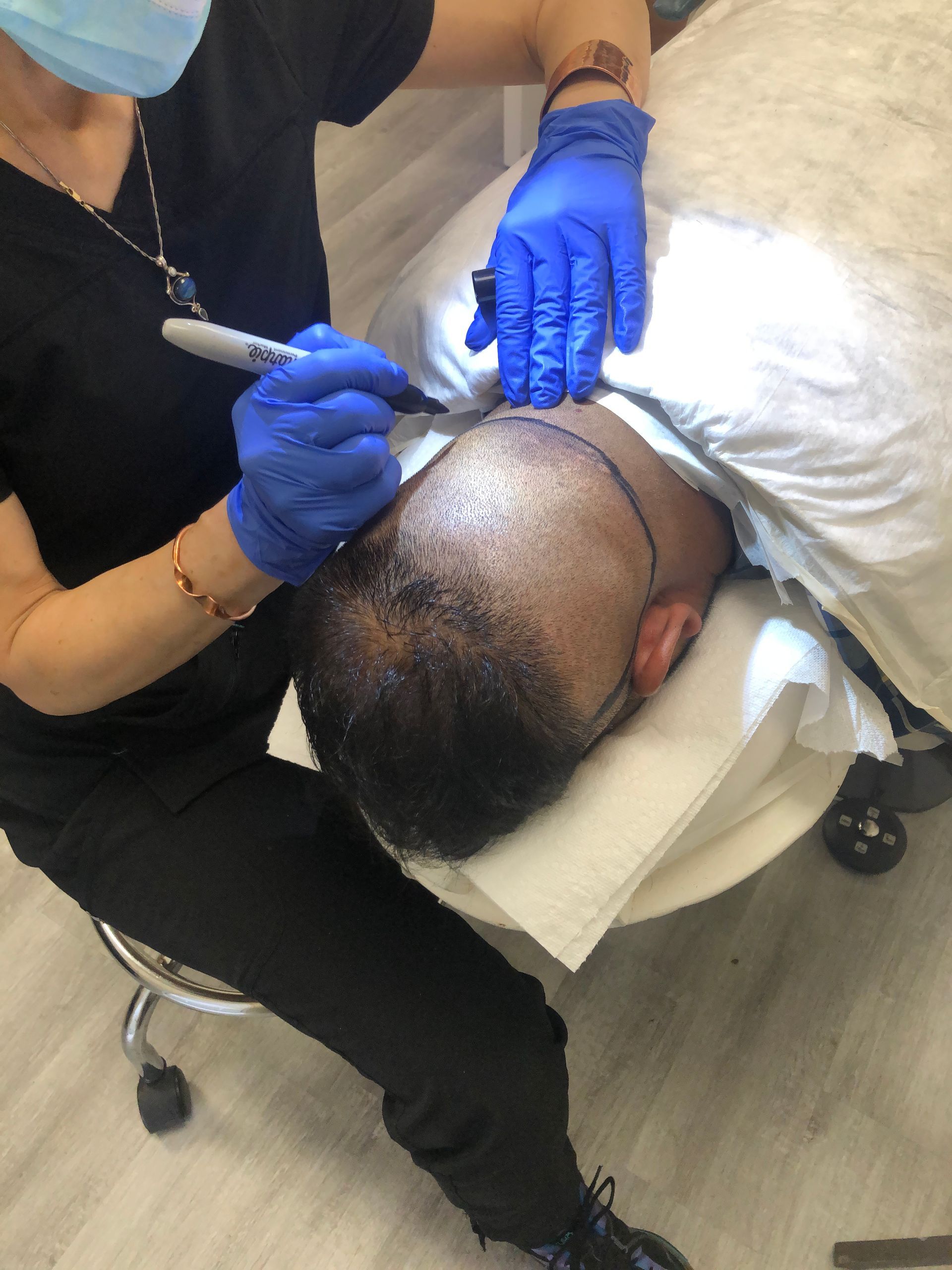A medical professional in blue gloves and a mask uses a marker to draw a hairline on a patient's scalp for a procedure.