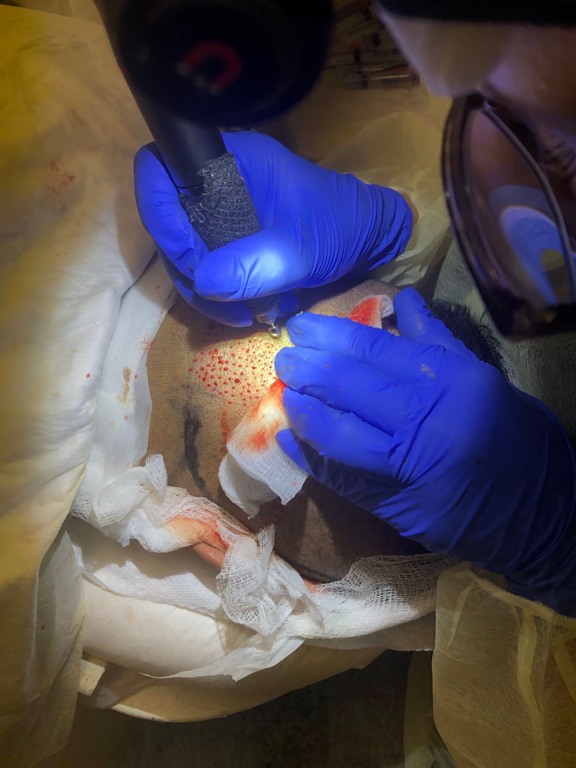 A clinician in blue gloves performing a hair transplant procedure on a patient's scalp using a surgical tool.