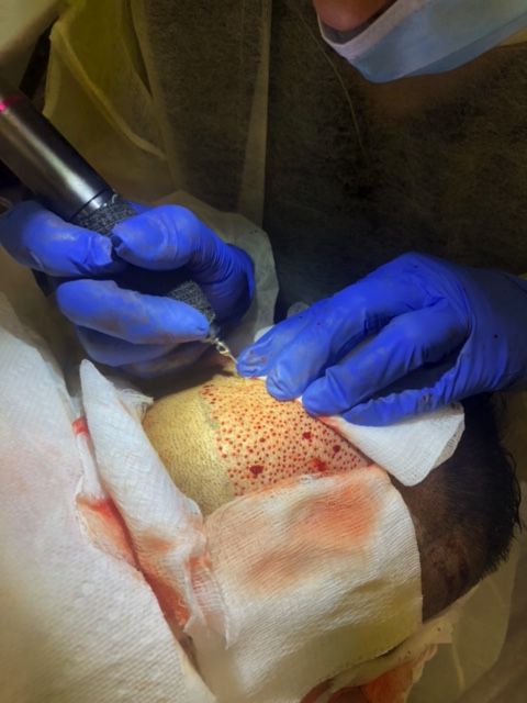 A clinician wearing blue gloves uses a device to implant hair follicles into a patient's scalp.