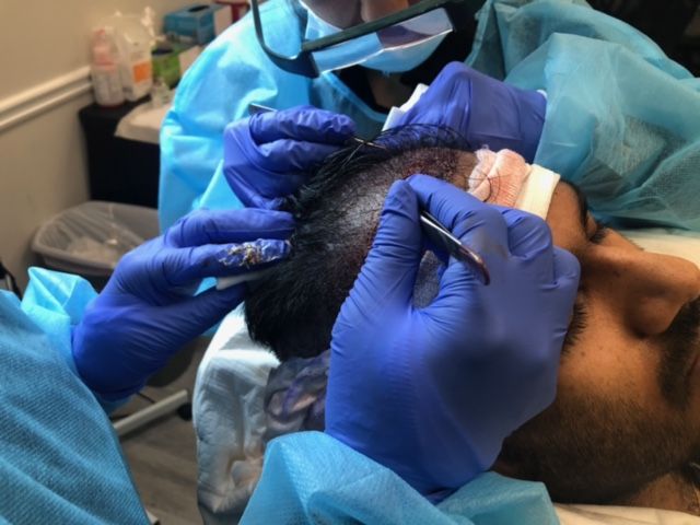 Medical professional wearing blue gloves performing a hair transplant procedure on a patient's scalp.