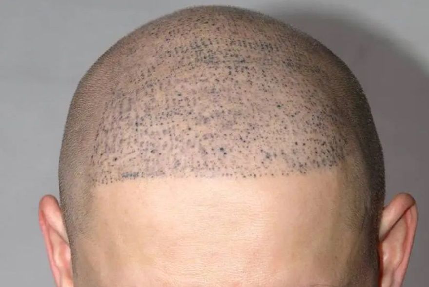 A shaved scalp with a dense pattern of small, dark dots across the front, typical of scalp micropigmentation.