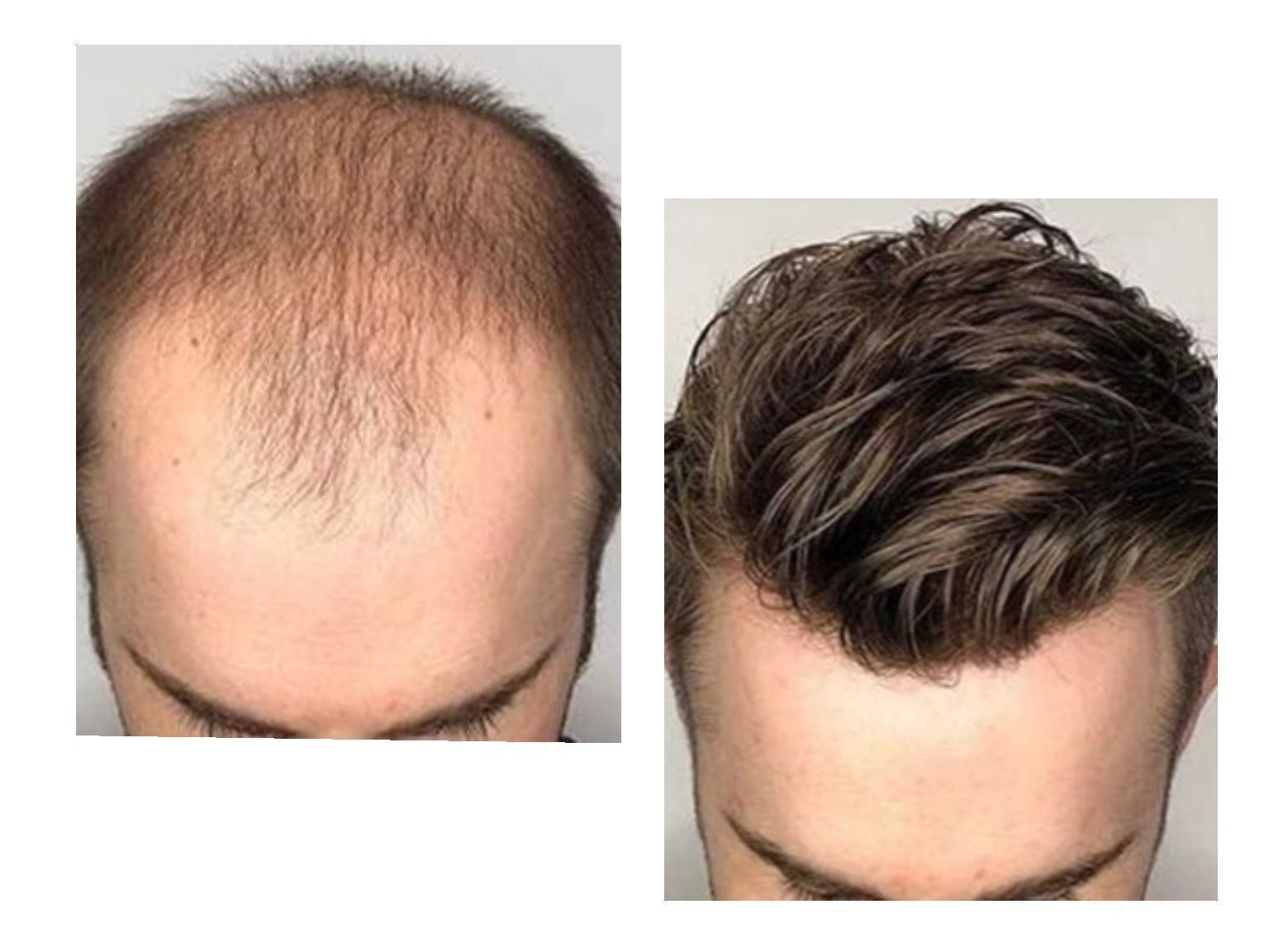 A before and after comparison of hair regrowth, showing sparse hair on the left and full, styled hair on the right.