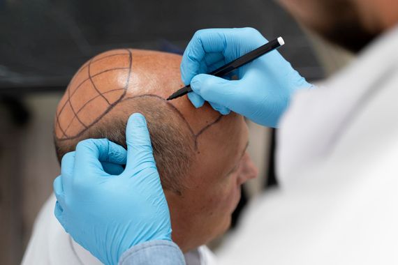 A person in blue medical gloves uses a marker to draw a dotted hairline guide on a person's forehead.