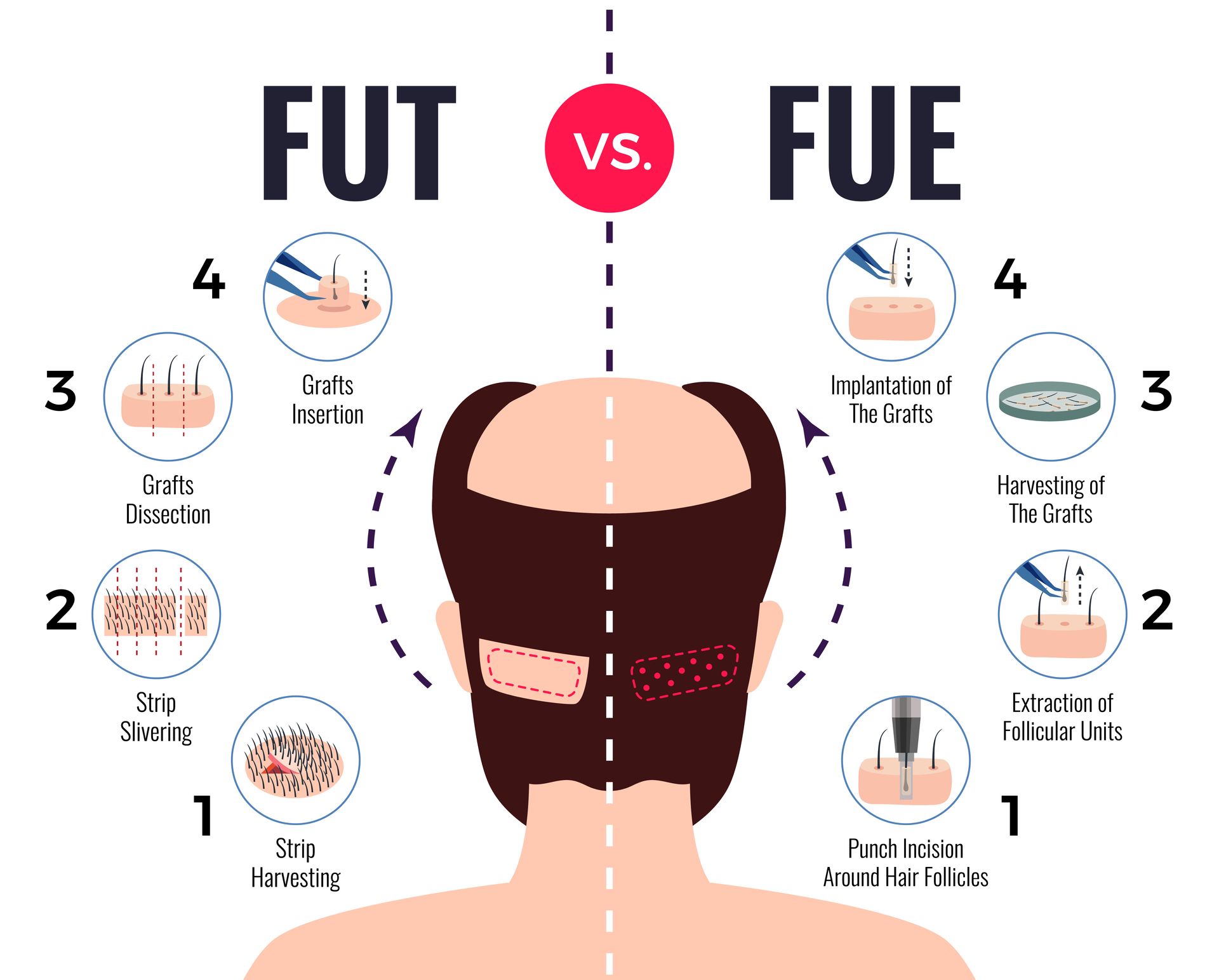 Diagram comparing FUT (Follicular Unit Transplantation) and FUE (Follicular Unit Extraction) hair transplant methods.
